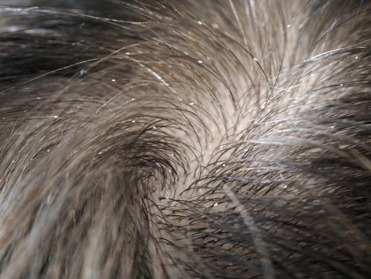 Person’s hair with numerous nits